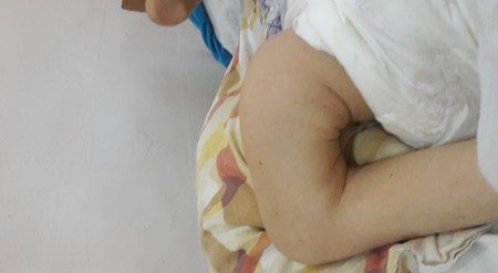 Fractura piciorului pacientei