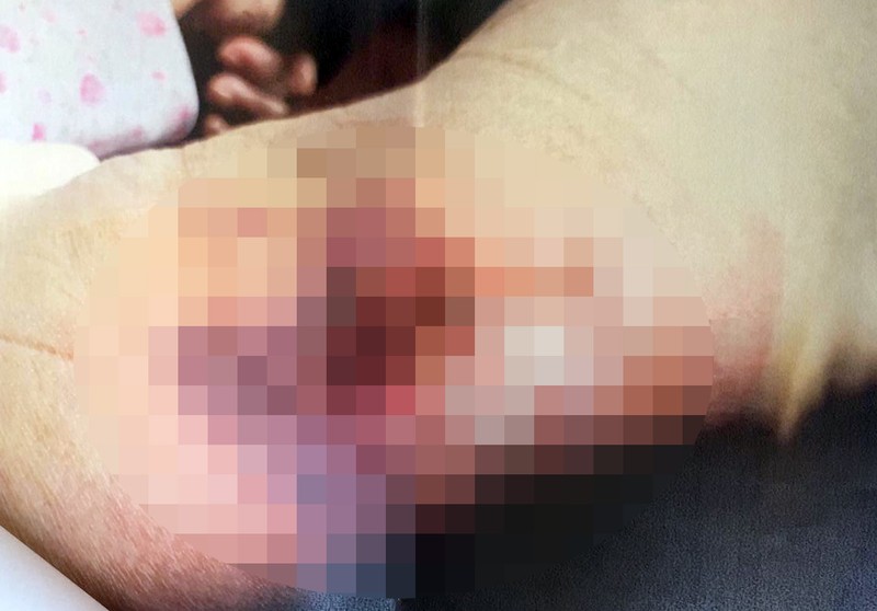 Escara de pe un membru. Redacția Libertatea a ales să blureze părți din imagini, întrucât consideră că pot aduce atingere demnității persoanei prezentate, fără a aduce un beneficiu interesului public.