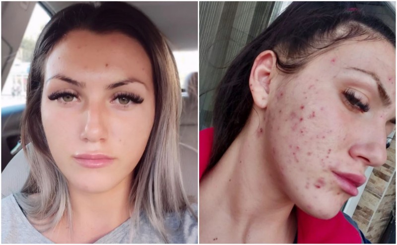 Alexandra Culuși, înainte și după ce a urmat tratamentul pentru acnee recomandat de Ioana Marinescu