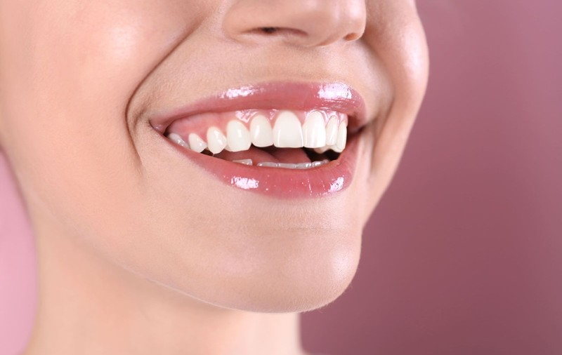 Hollywood smile: cât costă să îți refaci zâmbetul cu fațete dentare