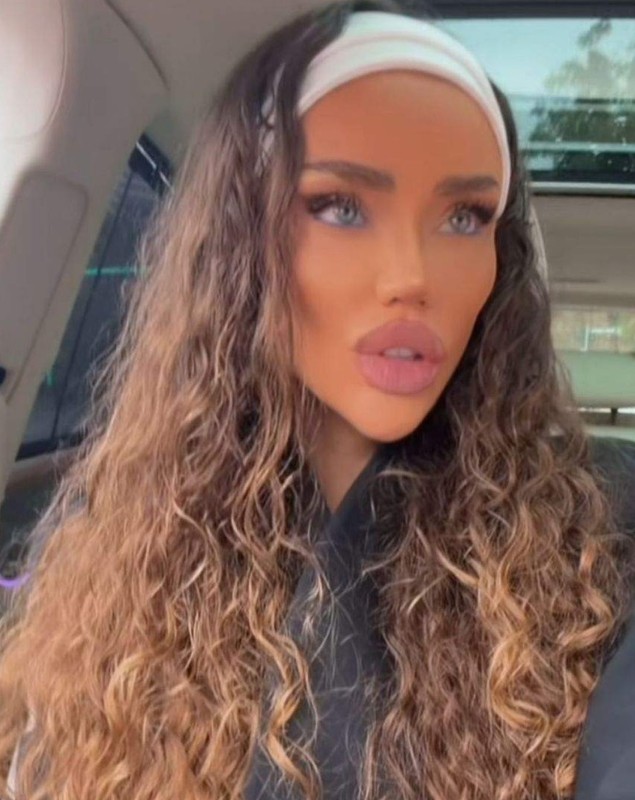Bianca Drăgușanu și-a topit acidul hialuronic din buze din nou: „Acum sunt aproape de forma care îmi place”. La operațiile estetice nu renunță