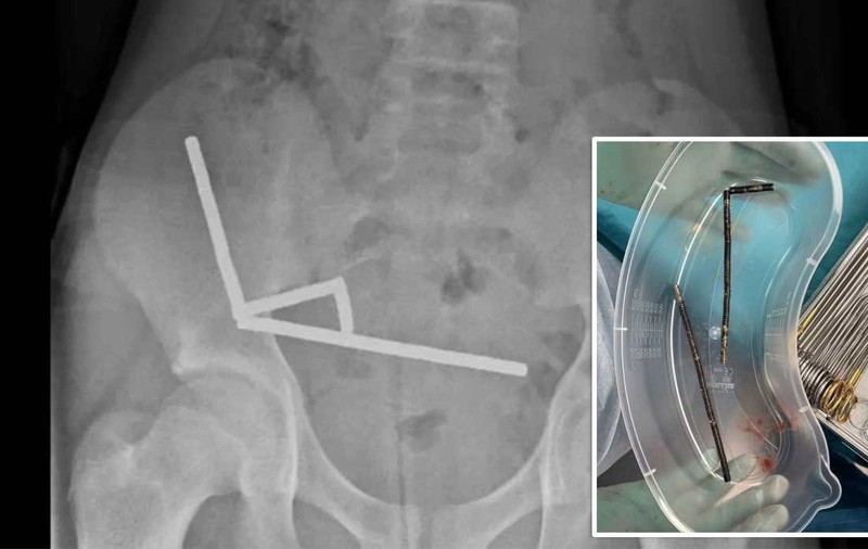 Băiat de 13 ani, operat de urgență după ce a înghițit 100 de magneți cumpărați de pe Temu