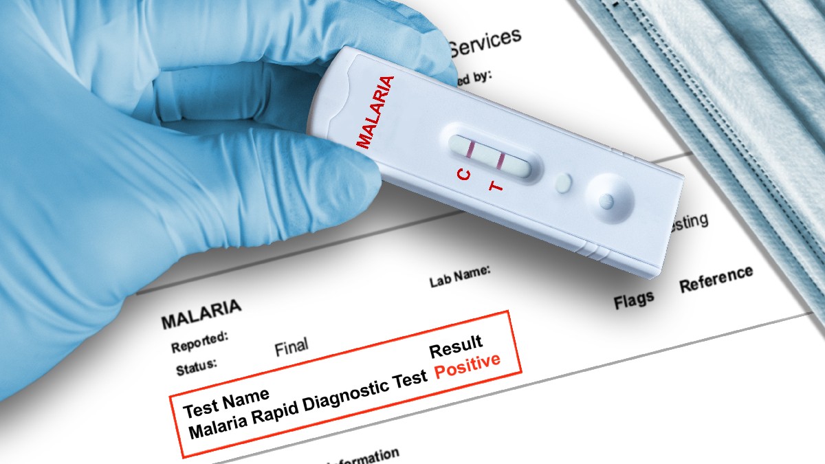 Rezultat pozitiv al testului pentru malarie, indicând prezența paraziților malarici, obținut cu ajutorul unui dispozitiv de diagnostic rapid, ținut în mănușă medicală