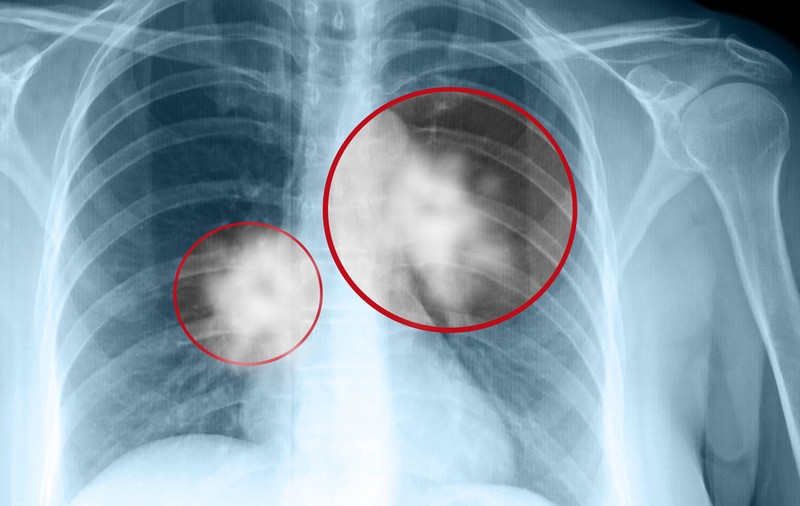SIMPTOME MAI PUȚIN CUNOSCUTE ALE CANCERULUI PULMONAR