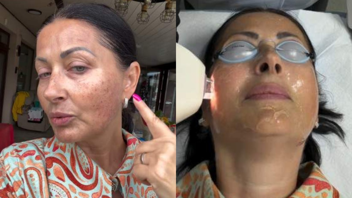 Gabriela Cristea, tratament facial cu laser