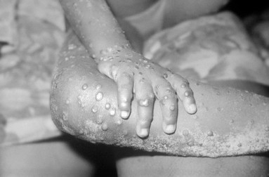 Infecția cu variola maimuței la fetiță de 4 ani din Liberia, 1973. Foto: Profimedia