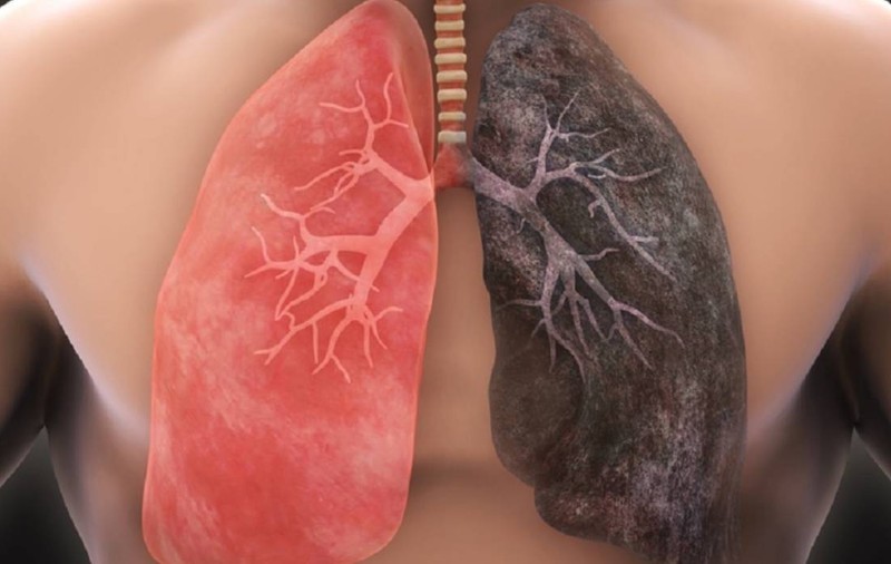 Spitalul „Victor Babeș” Timișoara, apel pentru un program de prevenție și screening în cancerul pulmonar: „Un român moare în fiecare oră”
