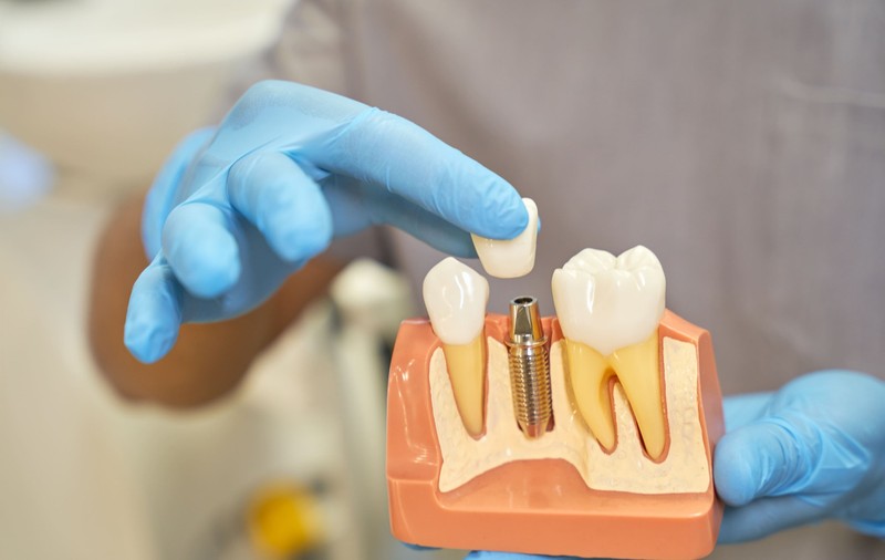 Implanturi dentare premium: Ce diferențiază tipurile de implant