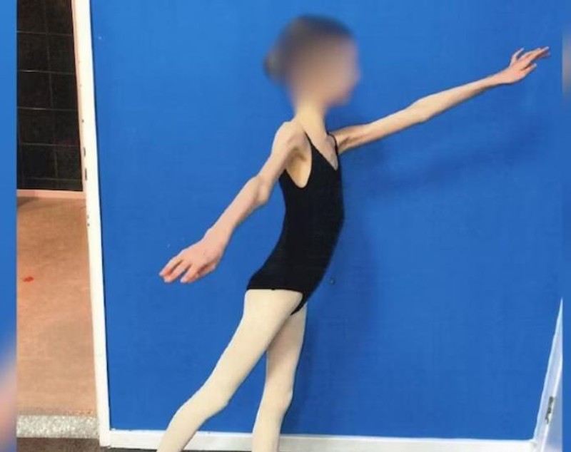 Doi părinți și-au înfometat fiica pentru că doreau să rămână mică. Fata de 17 ani ajunsese să cântărească 27,3 kilograme