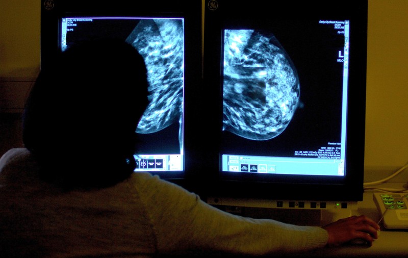 O formă agresivă de cancer de sân afectează mai mult femeile de culoare - Studiu