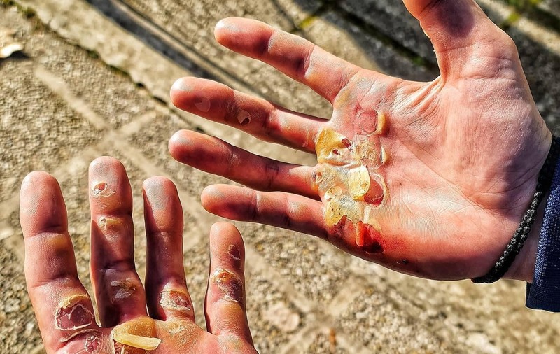 Cum arată palmele unui canotor după 24 de kilometri de vâslit. „Suntem mândri de tine, Ciprian Tudosă”