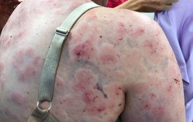 FOTO ȘOCANTE! Cum arată corpul unei femei care și-a apărat fetița cu propriul trup, în timpul unei furtuni cu grindină
