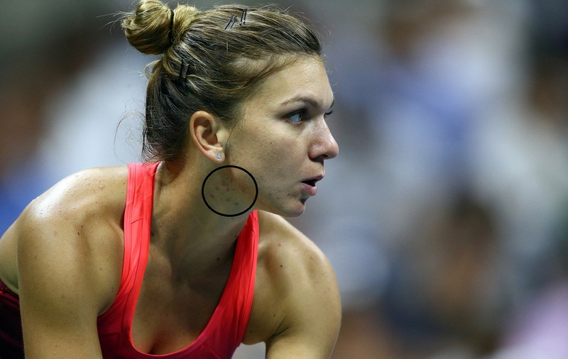 La US Open, n-are rivală pe teren, dar un adversar de temut nu-i dă pace! ^Simona Halep, răpusă de căldură? Campioana noastră suferă din pricina temperaturilor ridicate, care i-au produs bubițe pe gât și pe față