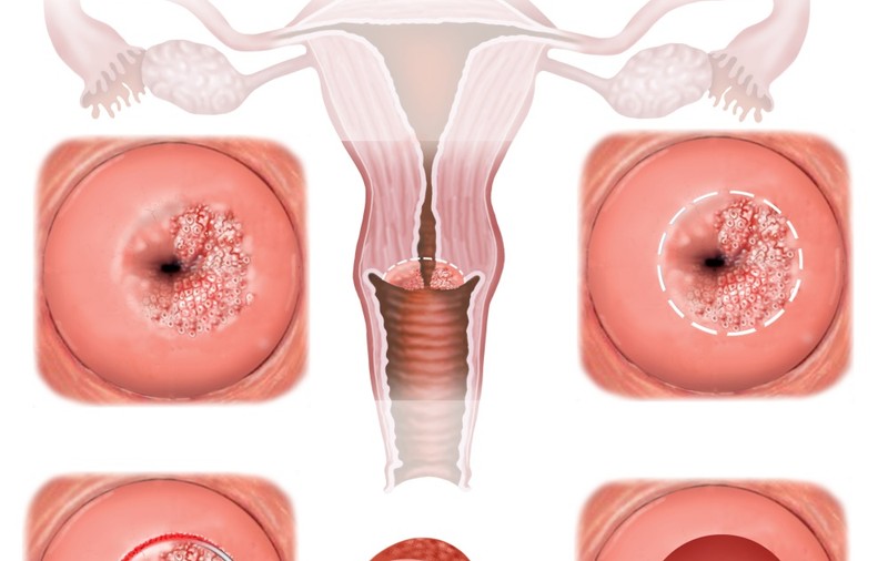 SIMPTOMELE CANCERULUI DE COL UTERIN