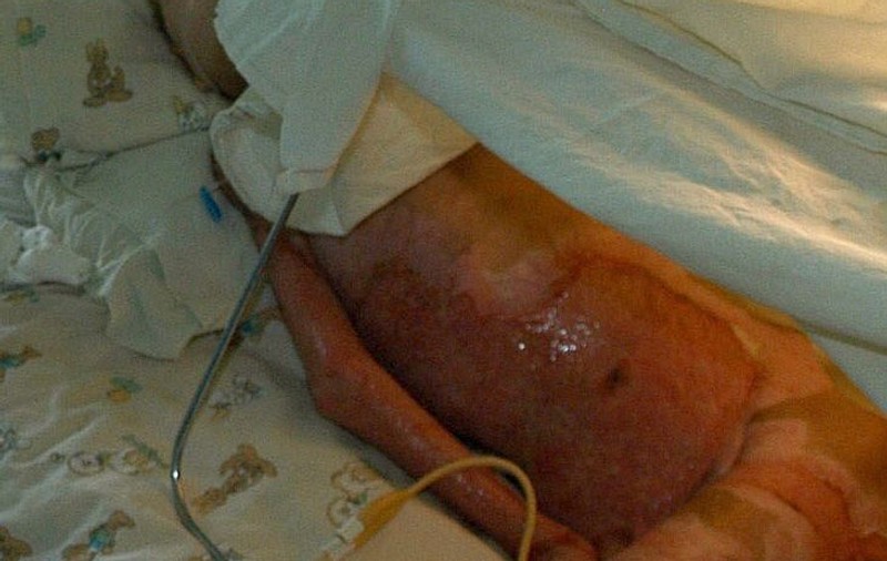 Un copil a ajuns la spital după ce a căzut în oala cu ciorbă 