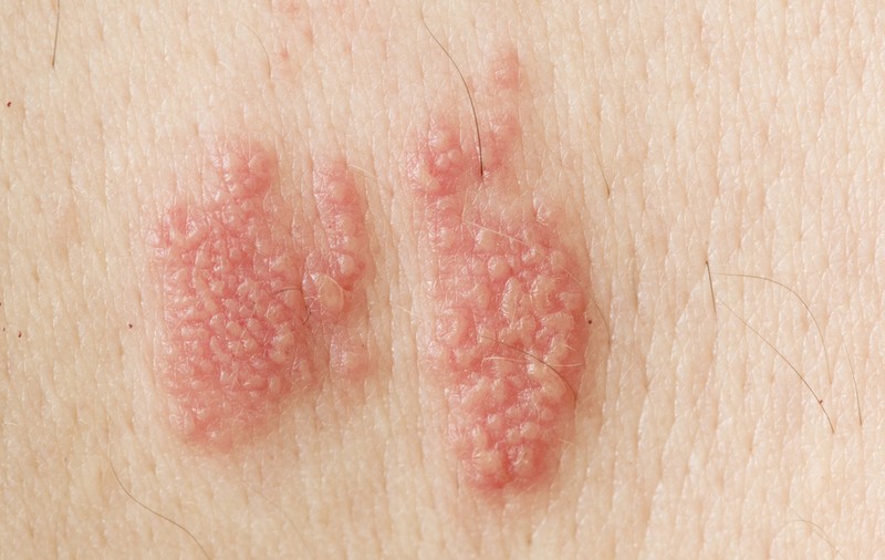 Ce trebuie să ştii despre herpes şi micozele genitale