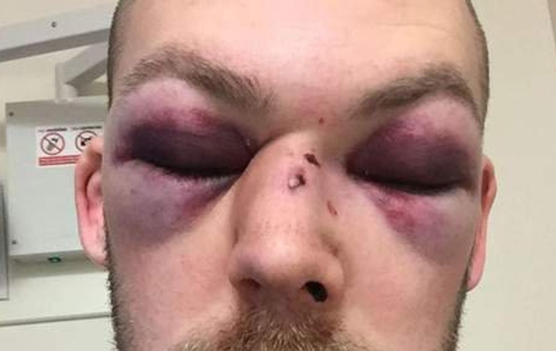 Un jucător amator de cricket a ajuns la spital cu fața tumefiată după ce a fost lovit cu o minge