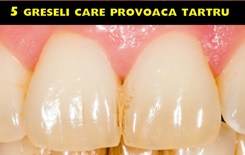 GREȘELI CARE DUC LA APARIȚIA TARTRULUI