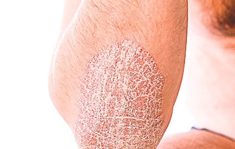 7 moduri de a ameliora psoriazisul