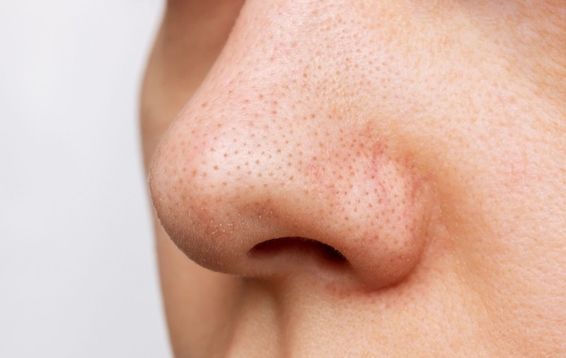 Cum să reduci apariția punctelor negre sau comedoanelor: sfaturi de la dermatologi