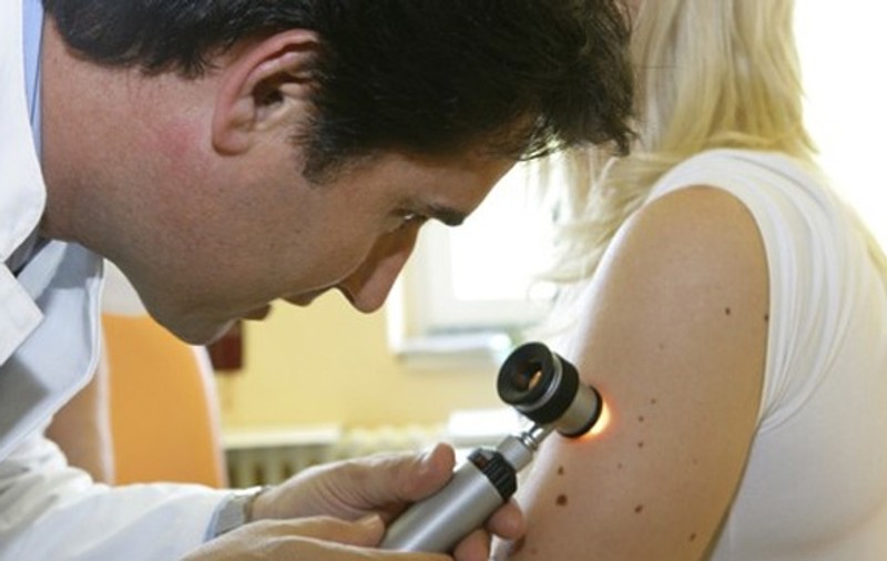 Atenţie la aluniţe: Melanomul, cea mai violentă formă de cancer!