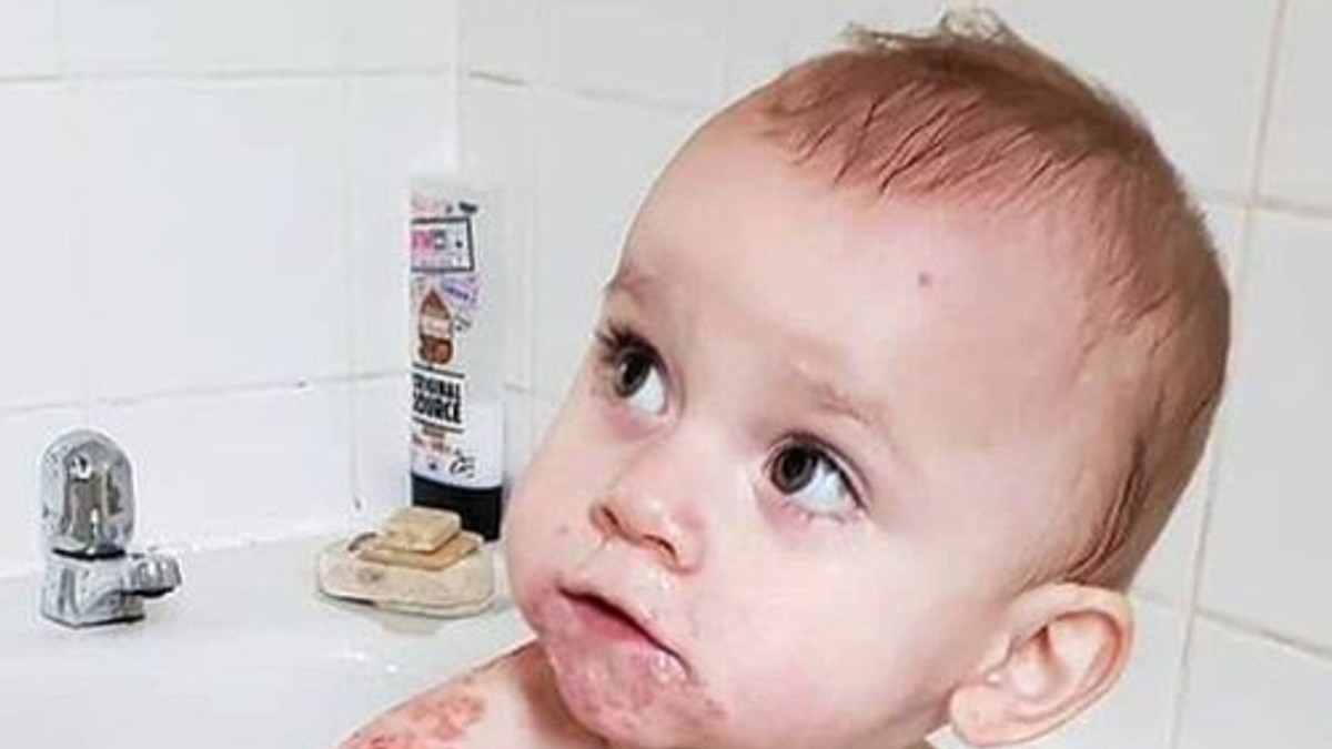 Un bebeluș a fost la un pas de moarte după ce un membru al familiei l-a pupat pe buze