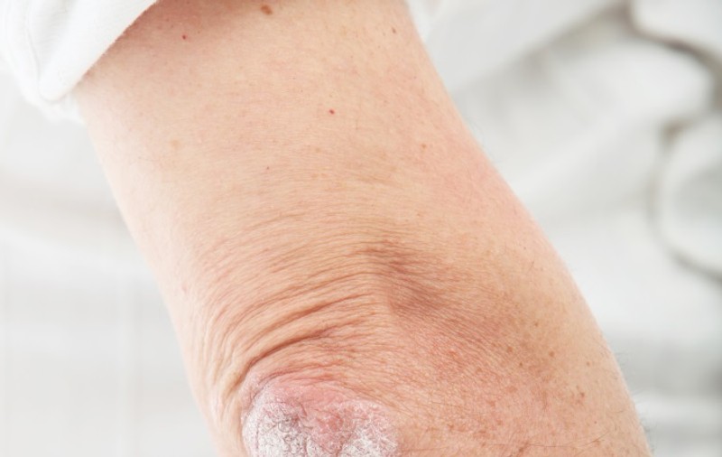 Psoriazisul - cum arată şi cum se tratează