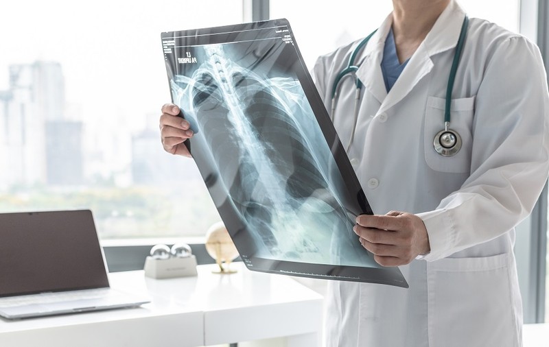 Mic ghid al pacientului în fața cancerului bronho-pulmonar - de la diagnostic la strategii de tratament