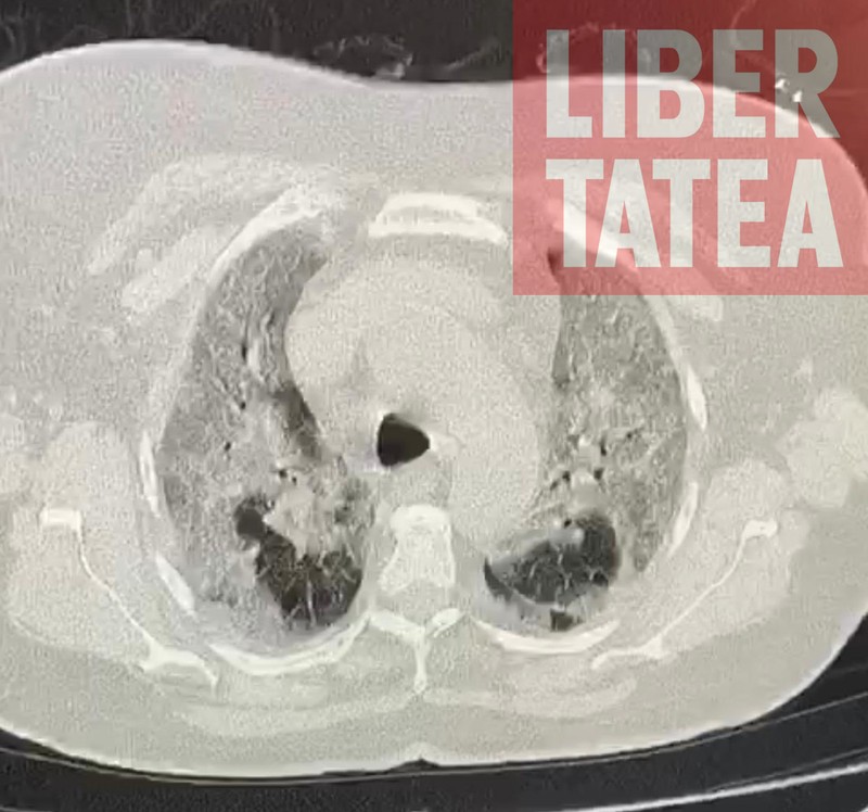 Plămânul afectat de coronavirus - forma severă | Foto: Arhiva laboratorului de imagistică medicală a Institutului de Pneumoftiziologie Marius Nasta