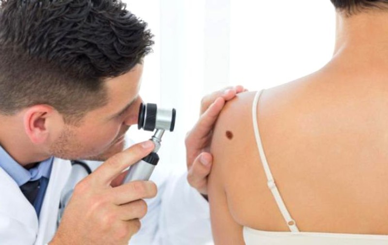 Un copil expus la soare riscă la maturitate cancerul de piele. Ce spun medicii