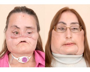 Connie Culp, înainte și după operație FOTO: EPA