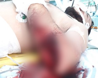 Nicolae Victor este încadrat în gradul I de handicap grav cu însoțitor, având un picior amputat, iar celălalt picior și brațul stâng îi sunt grav afectate