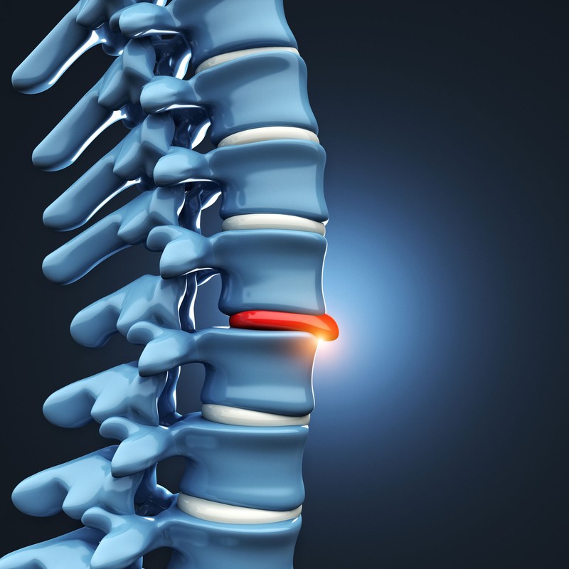 disc hernizat