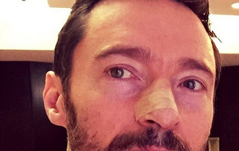Hugh Jackman,  operat a cincea oară de cancer de piele! Apel către fani!