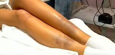 Bianca Drăgușanu a vorbit despre vânătăile de pe picioare