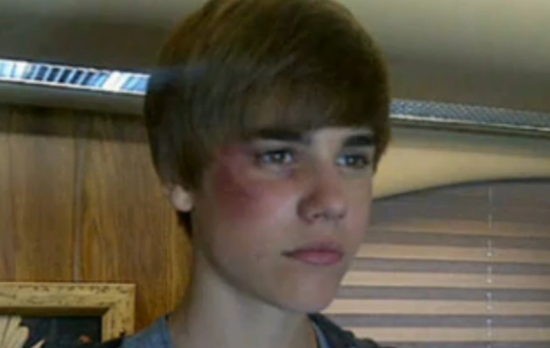 Justin Bieber e un bătăuş? Cântăreţul s-a ales cu un ochi vânăt 