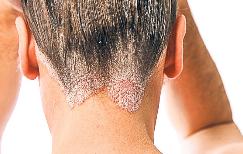 Cum să ameliorezi simptomele psoriazisului