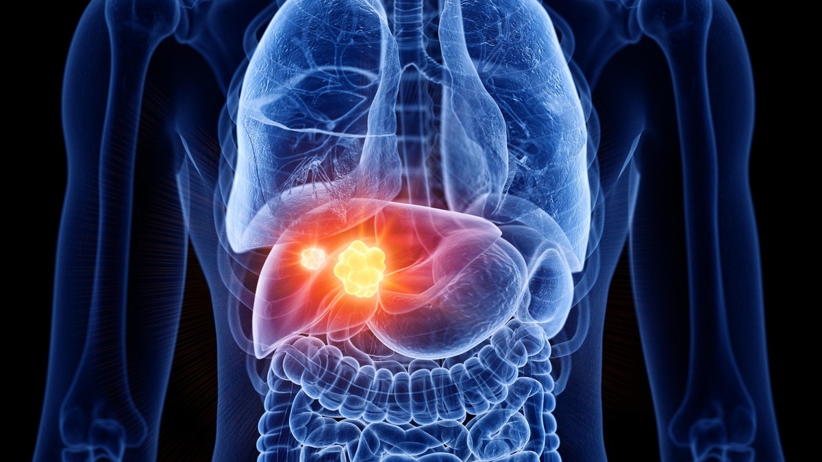 Ilustrație cancer hepatic