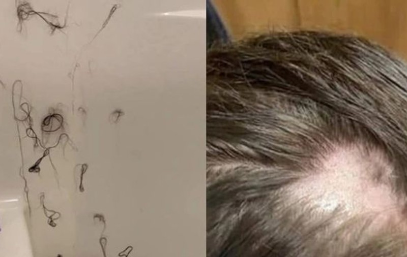 A rămas fără păr după ce a folosit un balsam