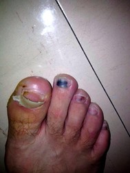 Unghia ruptă și bătăturile lui Dudi Sela. Problemele medicale se produc de la transpirație, după ore întregi de efort făcut la intensitate sporită