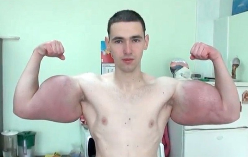 Un rus s-a visat Popeye, dar era să moară din cauza mușchilor falși. ”A blocat fluxul sanguin”. Bătut și părăsit de iubită