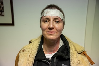 Mihaela trebuie să facă fotografii constant pentru a vedea cum evoluează vindecarea pielii