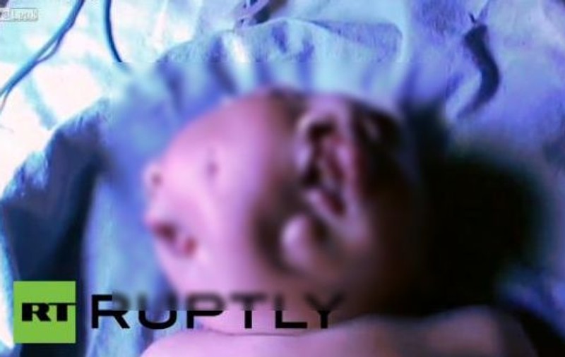 ŞOCANT! Un copil născut cu DOUĂ FEŢE se chinuie să trăiască! | VIDEO 