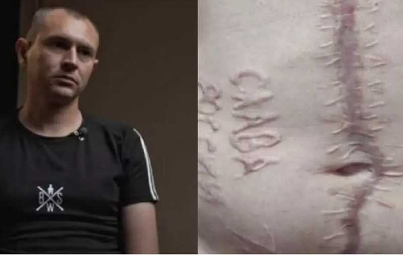 Chirurgii care l-au ars pe abdomen cu fierul încins pe un prizonier ucrainean cu inscripția „Slavă Rusiei”: „I-am găsit! Ce poate fi mai sadic de atât?”