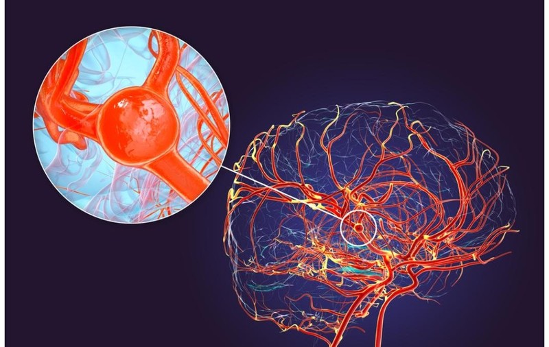 foto: angiografie cerebrala