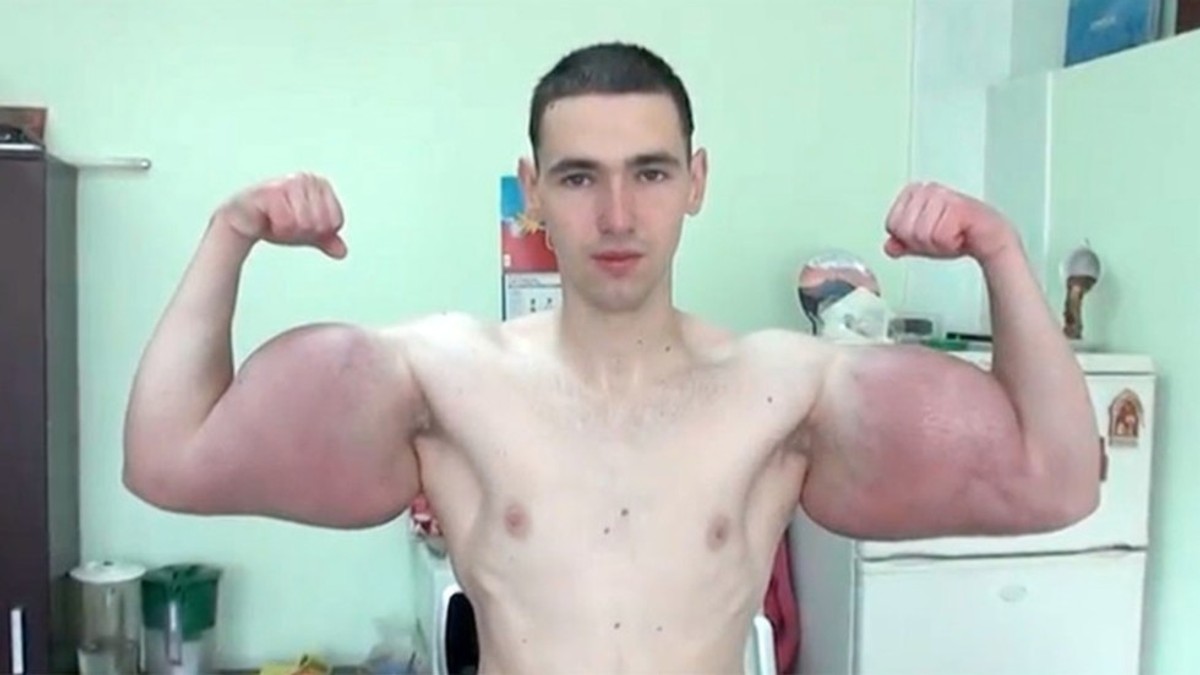 Un rus s-a visat Popeye, dar era să moară din cauza mușchilor falși. ”A blocat fluxul sanguin”. Bătut și părăsit de iubită