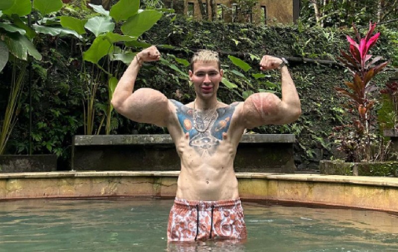 „Popeye”, influencerul care și-a injectat ulei în brațe ca să impresioneze pe net, a ajuns la spital: „Operație de îndepărtare a bicepșilor”