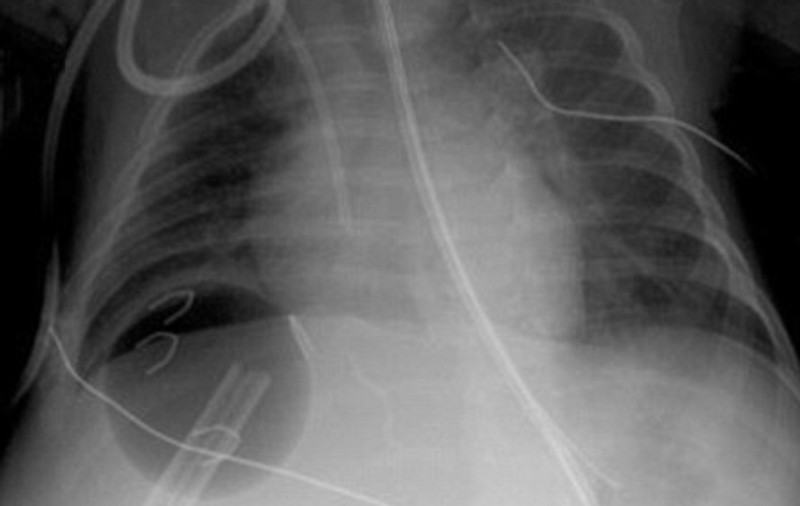 I-au implantat o minge de ping-pong sub ficat