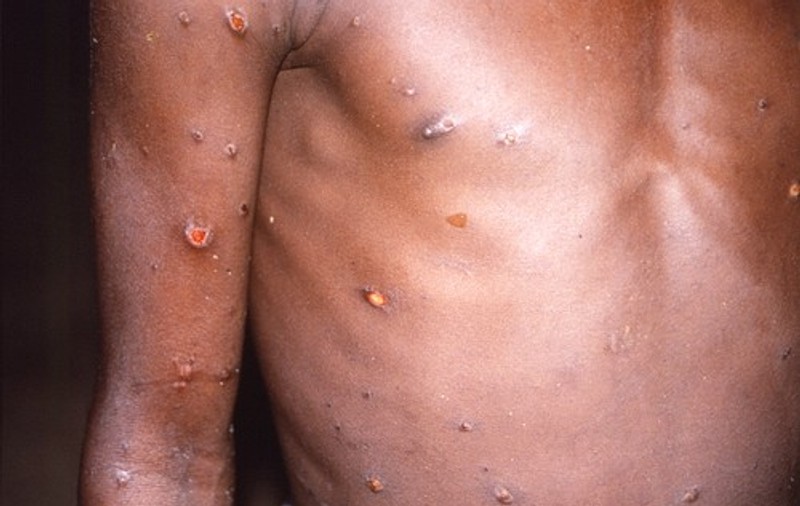 OMS anunță că nu este nevoie urgentă de vaccinare în masă contra variolei maimuței
