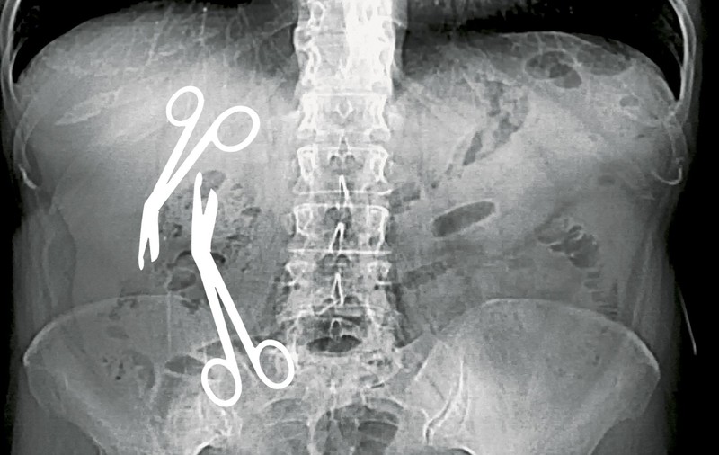 INVESTIGAȚIE EXCLUSIVĂ/ Directorul medical al Spitalului Militar din Constanța a uitat două foarfeci de 16 cm în burta unei paciente de 61 de ani!